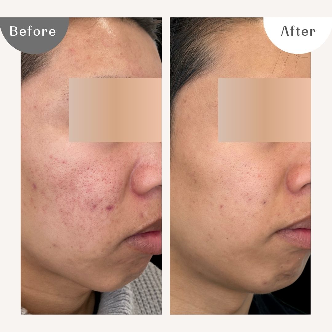 DAILY SKIN CLINIC Before