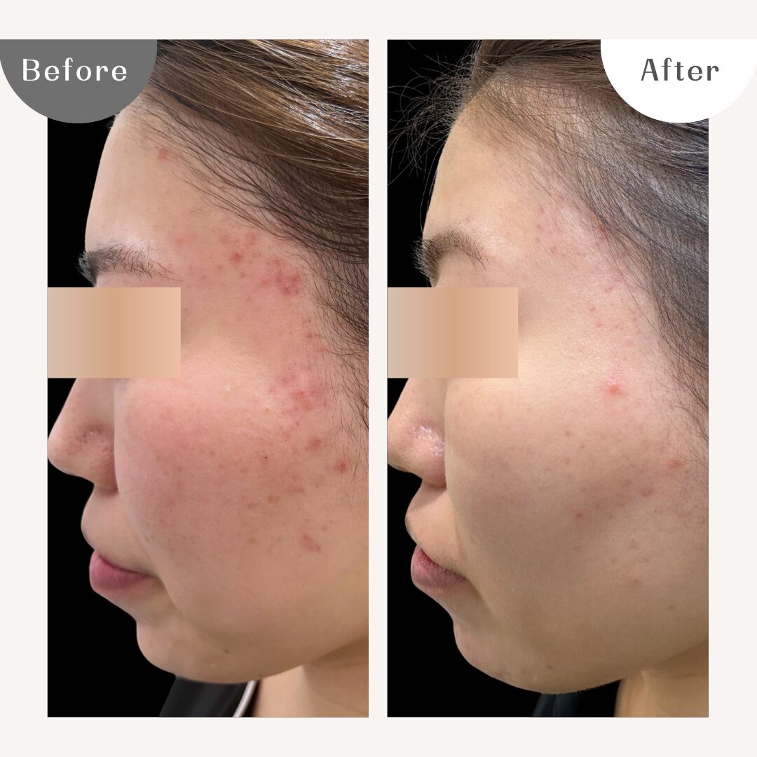 DAILY SKIN CLINIC 症例2