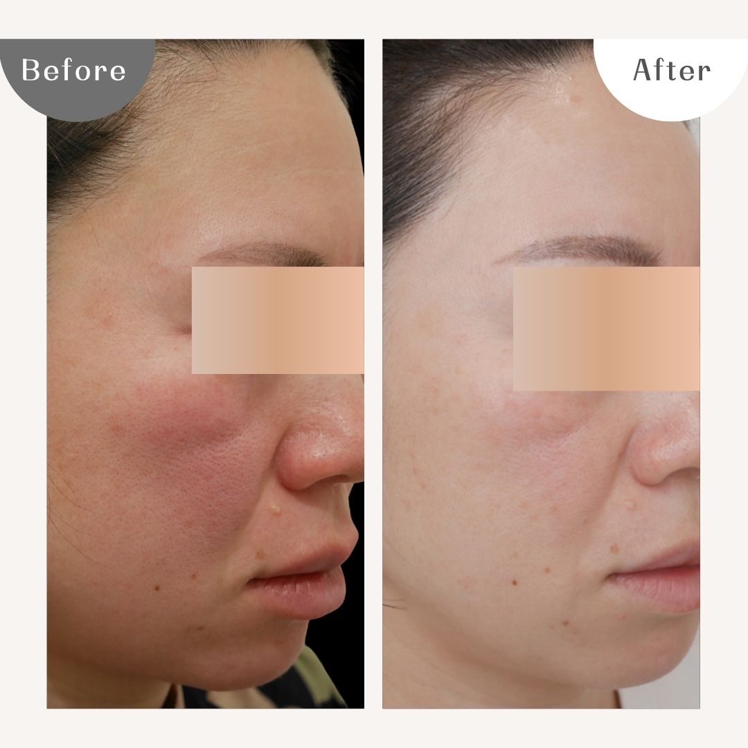 DAILY SKIN CLINIC 症例3