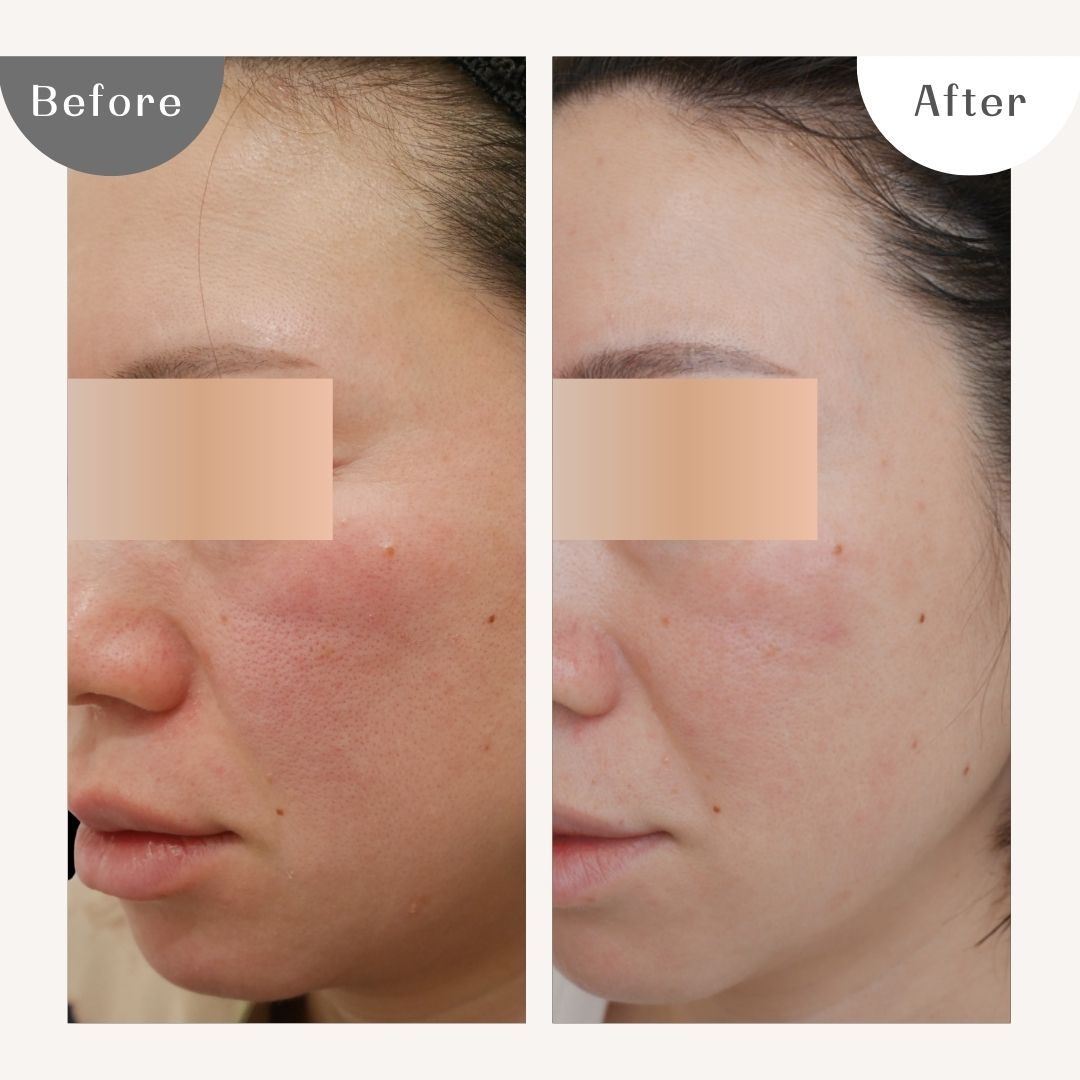 DAILY SKIN CLINIC 症例4