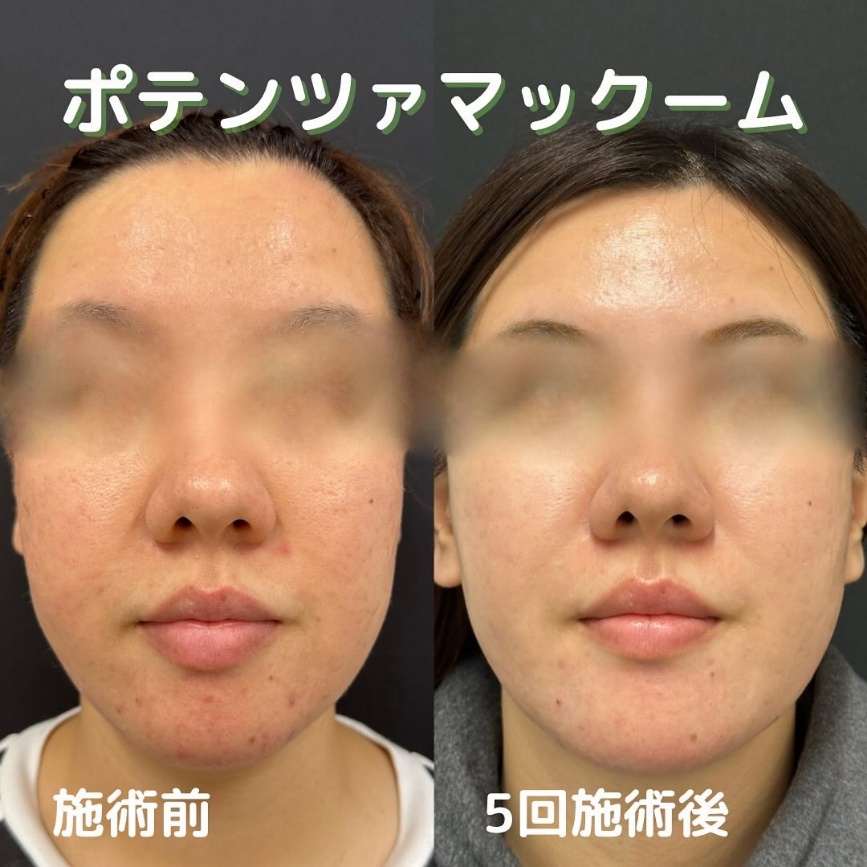 ルラ美容クリニック ポテンツァニキビ跡マックーム症例