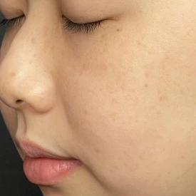 ルメッカ5回施術後