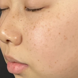 ルメッカ施術前