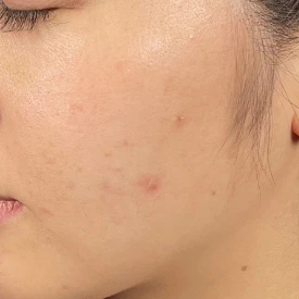 ルメッカ5回施術後