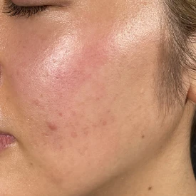 ルメッカ施術前