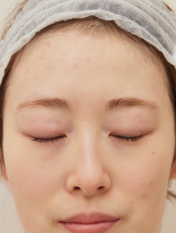 リゼクリニック After