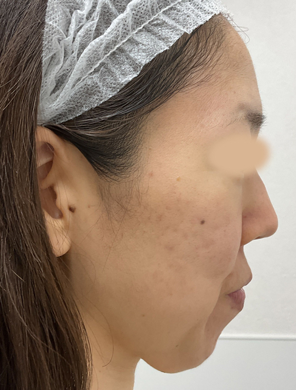 リゼクリニック After