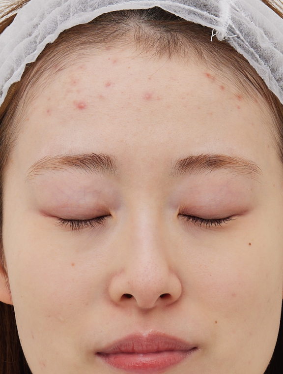 リゼクリニック Before