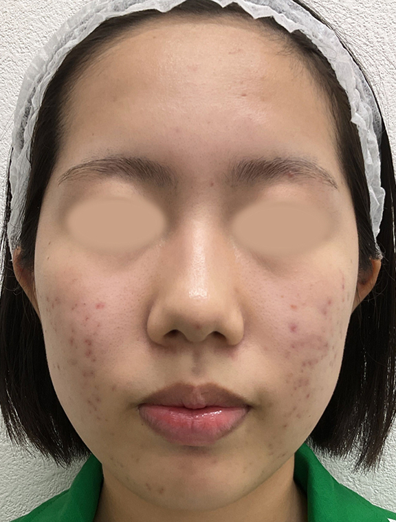 リゼクリニック Before