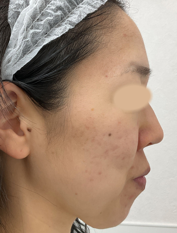 リゼクリニック Before