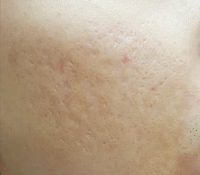 品川美容外科 After