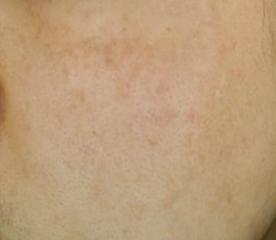 品川美容外科 After