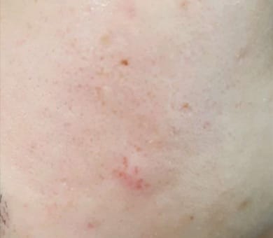 品川美容外科 After