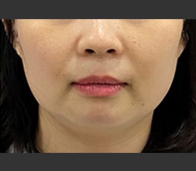 品川美容外科 After