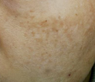 品川美容外科 Before