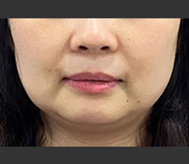 品川美容外科 Before