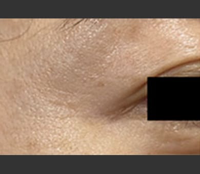 品川美容外科 Before