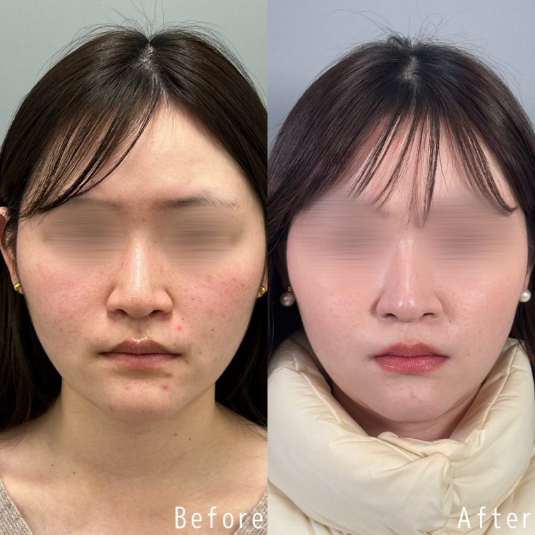 TCB ポテンツァ 症例