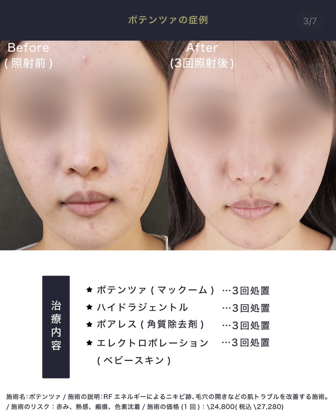 Tokyo Tensei Clinic 症例1