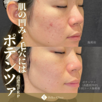 Fellezクリニック ポテンツァ