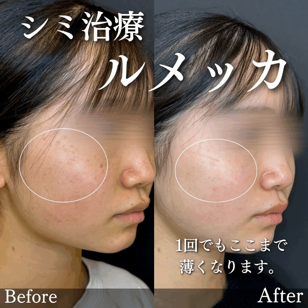 ルラ美容クリニック ルメッカ 症例写真 2