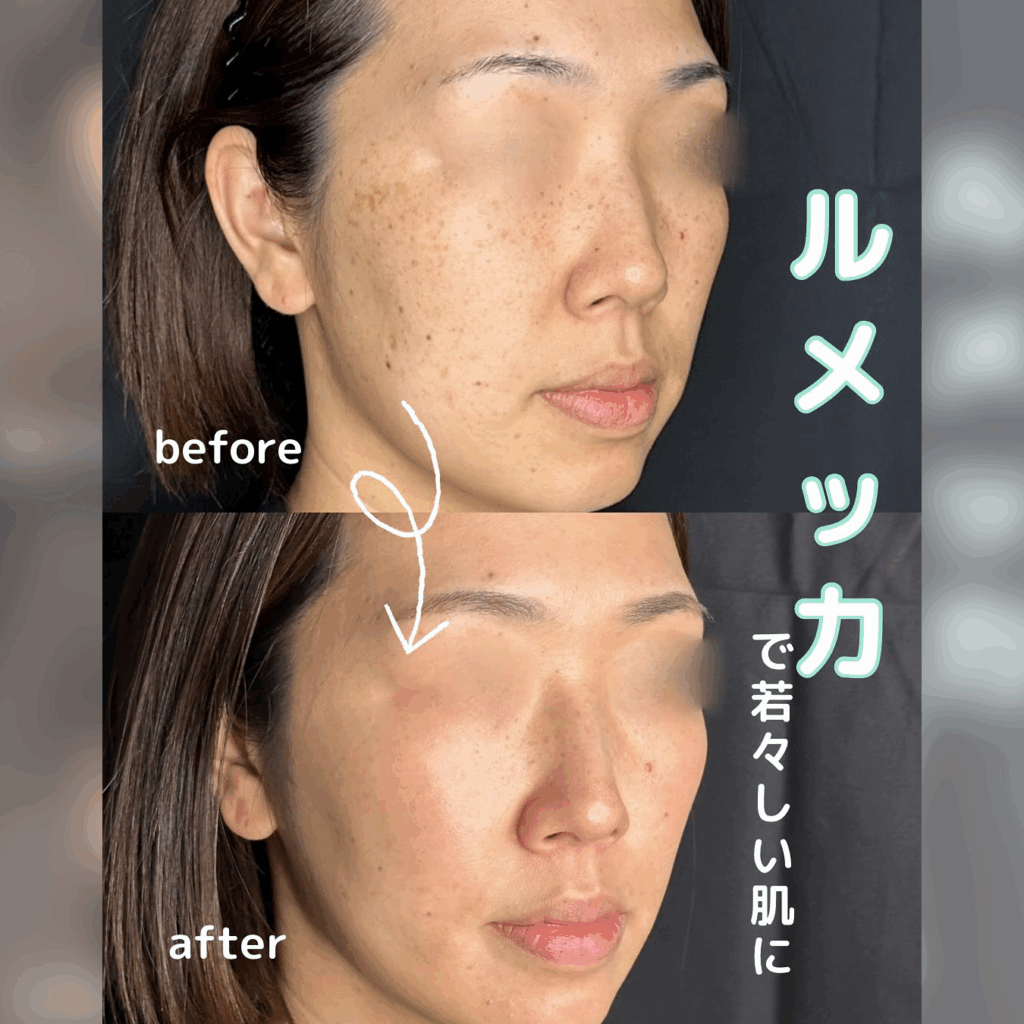 ルラ美容クリニック ルメッカ 症例写真 1