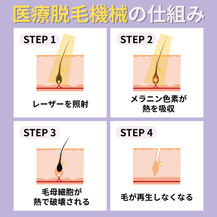 医療脱毛機械の仕組み