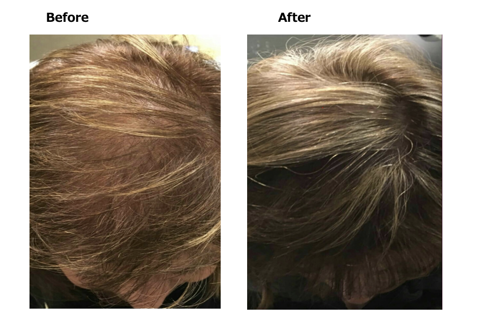 dr.cyj ヘアフィラー養毛・育毛・白髪・2セット入り2回分 DR.CYJ 投げ込ま 