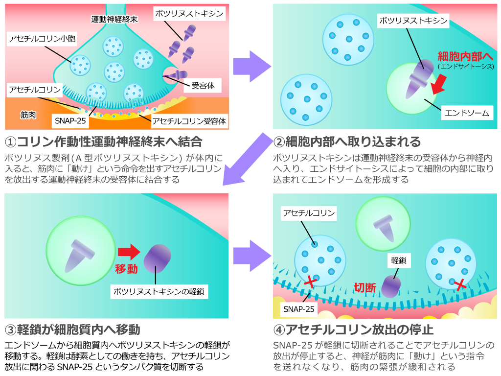 ボツリヌス注射で叶う美容効果とその仕組み(前編) | スキンリファインクリニック（銀座・吉祥寺）