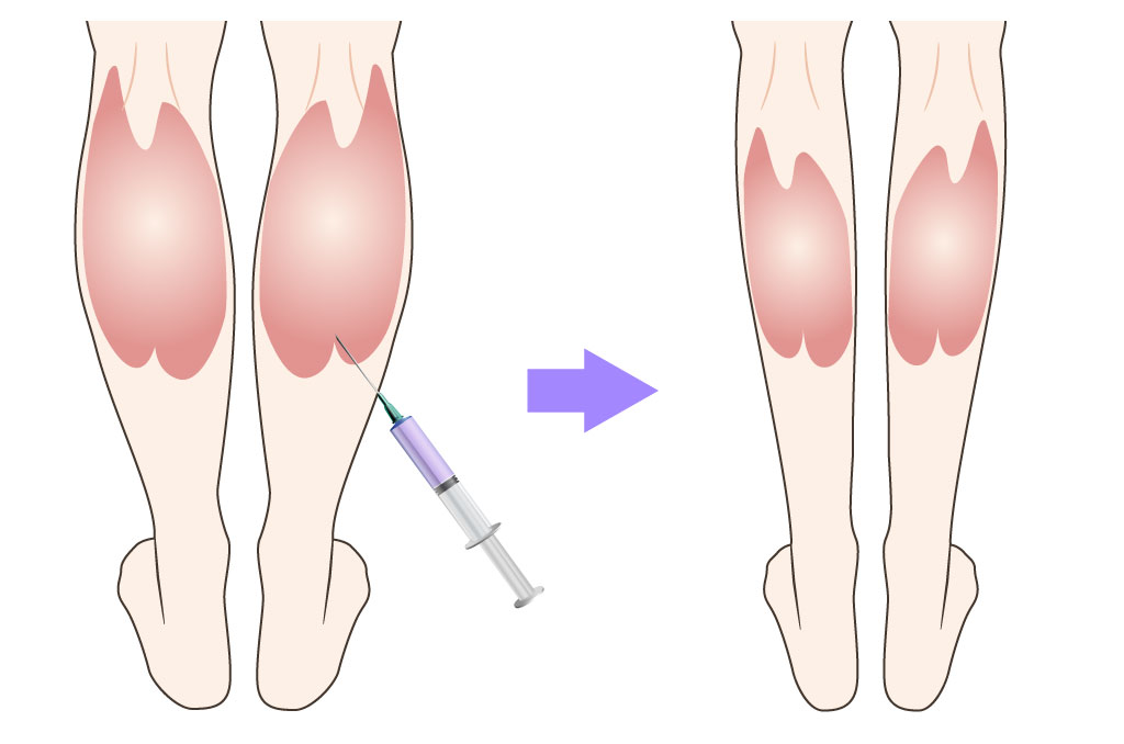 画像に alt 属性が指定されていません。ファイル名: calf_slimming.jpg